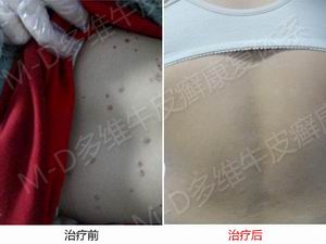 郑州银屑病专科治疗医院