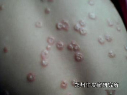 牛皮癣预防