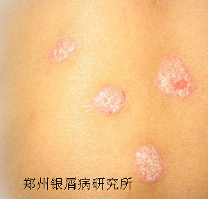 银屑病的预防