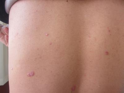 治疗多年的银屑病会变成皮肤癌吗